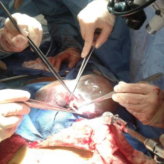 Paraguay aprueba ley para elevar donación de órganos