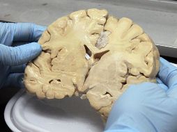 Pese a que la enfermedad es incurable, es importante brindar alternativas terapéuticas que les permitan incrementar su calidad de vida a los enfermos. NTX / ARCHIVO