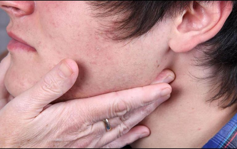 Destacan que el virus que causa esta enfermedad se transmite por secreciones respiratorias, y el contagio ocurre de persona a persona. ESPECIAL / dgcs.unam.mx