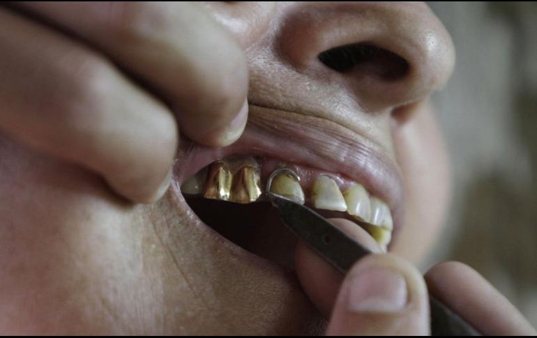 No es la comida entre nuestros dientes lo que nos enferma, son microbios específicos, es por lo tanto una infección que desencadena una respuesta inflamatoria que lleva a la destrucción del soporte del diente. AP / ARCHIVO