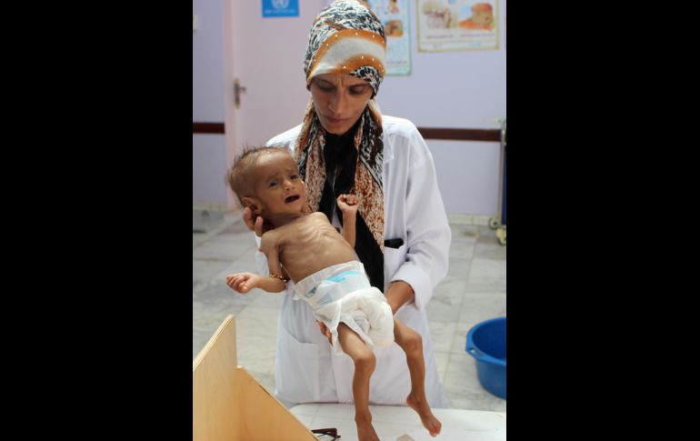 Una enfermera carga a un niño yemení que padece malnutrición severa en un hospital de Abs, Yemen. Agencias de Naciones Unidas señalan que 14 millones de personas en el país están en riesgo de hambruna. AFP/E. Ahmed