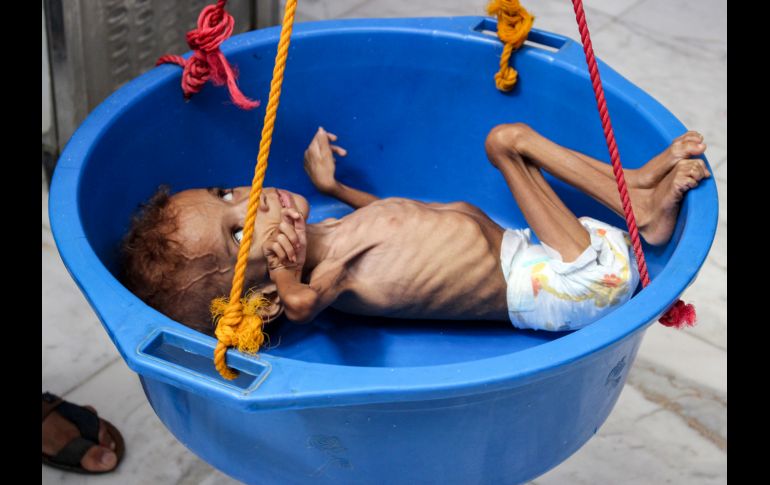Bassem Mohamed Hassan, un yemení de 2 años que sufre desnutrición severa, es pesado en un hospital en Abs, Yemen, el 19 de septiembre. AFP/E. Amhed