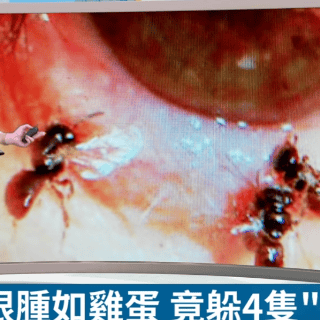 Encuentran 4 abejas vivas en el ojo de una mujer