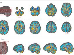Una muestra de las diferencias entre las tomografías de los pacientes analizados. AP/American Medical Association.