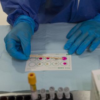 ¿Qué son las células madre que curaron por segunda ocasión el VIH?