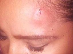 La lesionada presentaba un hematoma en la parte frontal izquierda, así como una herida de forma vertical de unos dos centímetros de magnitud. ESPECIAL