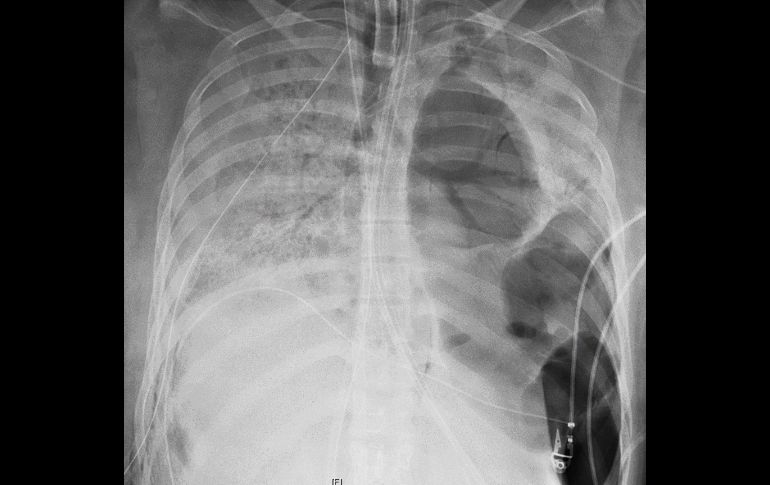 La enfermedad provocó grandes agujeros en su pulmón izquierdo, abriendo la vía a una infección bacteriana. Toma de rayos X de los pulmones de la paciente, antes del trasplante. AP/Northwestern Medicine