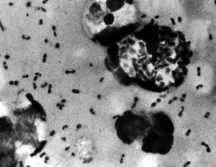 La peste bubónica se caracteriza por la inflamación de los ganglios linfáticos. GETTY IMAGES /