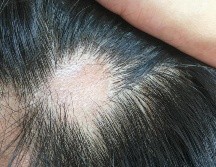 La caída del cabello causada por el coronavirus suele ser temporal. GETTY IMAGES