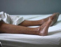 El síndrome de Guillain-Barré paraliza los músculos, pero la mayoría de las personas que lo contraen eventualmente se recuperan. GETTY IMAGES