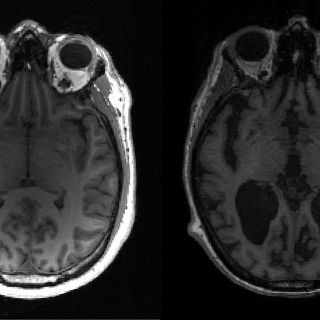 Científicos descubren causas del avance del mal de Alzheimer en el cerebro