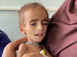 Un niño con desnutrición en Kandahar, en Octubre. GETTY IMAGES