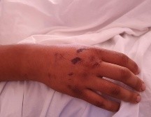 Giovanni Daniel, de 21 años, es una de las 26 personas lesionadas el sábado en el partido de Querétaro vs Atlas. En la imagen, su mano aún con heridas.  EL INFORMADOR/ E. GÓMEZ
