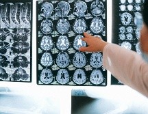 Investigadores proponen un nuevo modelo computacional relacionado con el Alzheimer. ESPECIAL/CORTESÍA MAYO CLINIC.