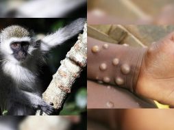 Aunque la mortalidad es baja, la viruela de mono puede ser más perjudicial en niño, así como en las mujeres embarazadas. ESPECIAL