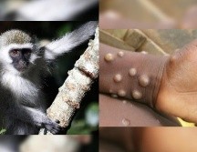Aunque la mortalidad es baja, la viruela de mono puede ser más perjudicial en niño, así como en las mujeres embarazadas. ESPECIAL