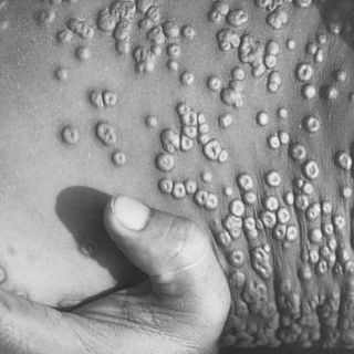 Viruela del mono: en qué se diferencia de la devastadora viruela humana erradicada hace 40 años