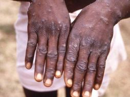 La viruela del mono ha preocupado a la población y especialistas por el aumento de casos a nivel internacional. ESPECIAL