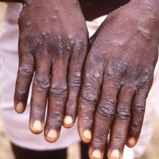 ¿La viruela del mono es una enfermedad de transmisión sexual?