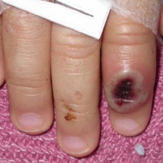 Viruela del mono: La OMS alerta que aparecerán más casos