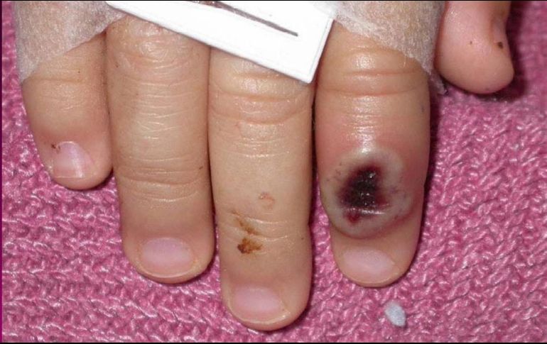 La inmunidad frente a esta enfermedad es muy escasa entre la población joven en vista de que el grupo por debajo de los 40 o 50 años no ha recibido la vacuna contra la viruela. EFE / Cortesía CDC