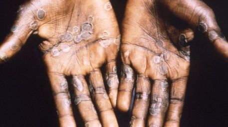 Pústulas características de la viruela del mono en paciente en la República Democrática del Congo. GETTY IMAGES