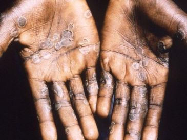 Pústulas características de la viruela del mono en paciente en la República Democrática del Congo. GETTY IMAGES