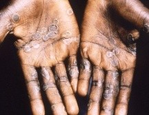 Pústulas características de la viruela del mono en paciente en la República Democrática del Congo. GETTY IMAGES