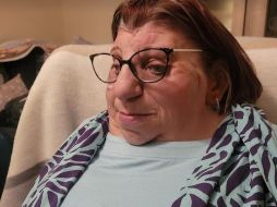 Janet Craven nació con un raro trastorno genético llamado síndrome de Treacher Collins.