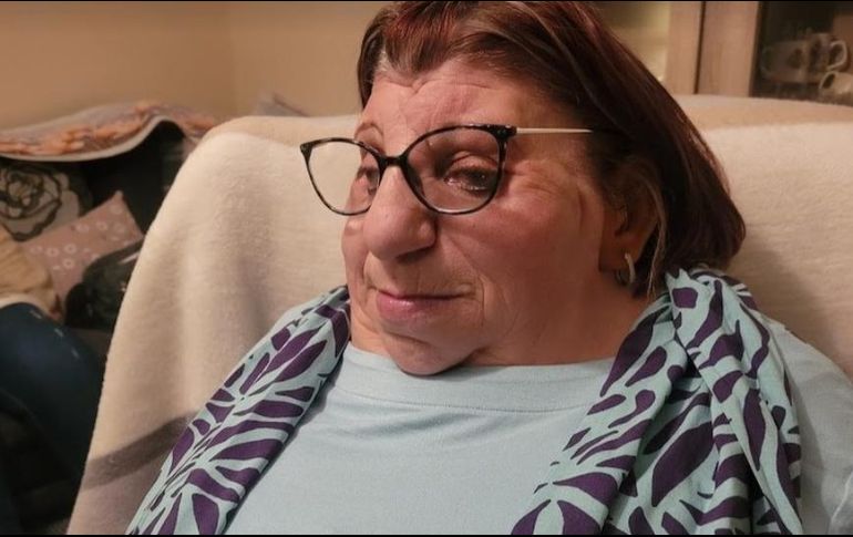 Janet Craven nació con un raro trastorno genético llamado síndrome de Treacher Collins.