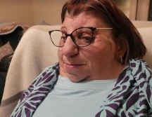 Janet Craven nació con un raro trastorno genético llamado síndrome de Treacher Collins.