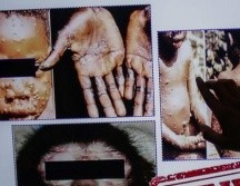 Es el mayor brote jamás visto en Europa: qué es esta enfermedad detectada ya en más de una decena de países y qué riesgos entraña para la salud. BBC_WEB