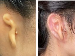 El implante fue fabricado a partir de células de la oreja del propio paciente. AFP/K. Bruno