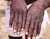 La enfermedad se localiza por lo general en el oeste y centro de África. ESPECIAL