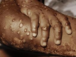 En Jalisco ya se presentó el primer caso de viruela del mono en Puerto Vallarta. ESPECIAL