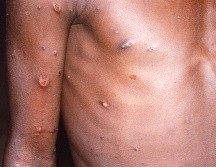 En Puerto Vallarta se registró el primer caso en Jalisco de Viruela del nono. ESPECIAL