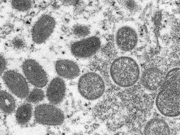 Imagen de microscopio que muestra virus maduros de viruela del mono de forma ovalada, a la izquierda, y virus inmaduros esféricos, a la derecha, obtenidos de una muestra de piel humana. AP/ARCHIVO