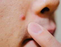 Conoce algunos mitos y realidades del acné en la mujer adulta. ISTOCK.