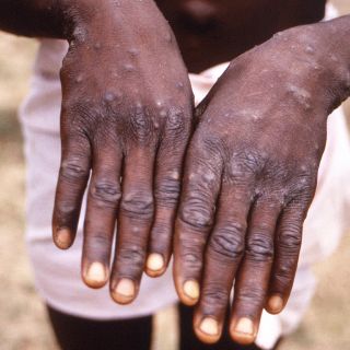 Debatirán, de nuevo, declarar emergencia internacional por viruela del mono