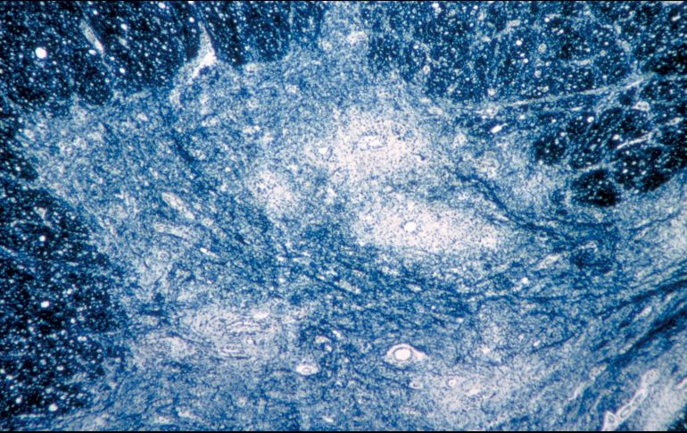 Aunque es una enfermedad incurable que puede causar parálisis muscular e incluso la muerte, la polio se puede prevenir con una vacuna, disponible desde 1955. AP/Emory University