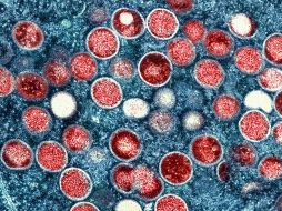 A la fecha se registran 13 casos confirmados de la viruela del mono en Jalisco. AP/NIAID