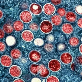 Esto es todo lo que sabemos de la viruela del mono en Jalisco