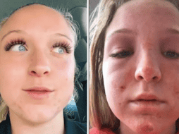 A pesar de que quedó con quemaduras en el rostro, Hoffstrom dejó claro que no iba a demandar al establecimiento. TikTok/ @emmahoffstrm