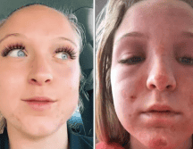 A pesar de que quedó con quemaduras en el rostro, Hoffstrom dejó claro que no iba a demandar al establecimiento. TikTok/ @emmahoffstrm