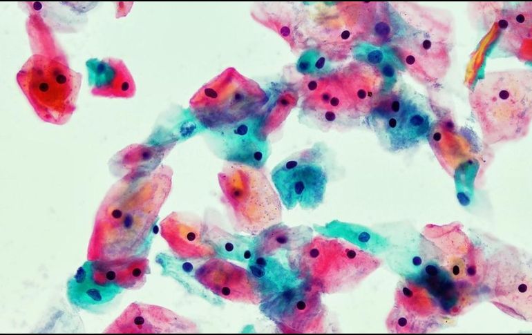 Un frotis citológico de vagina (tinción de Papanicolaou, x 1000), un ejemplo de un examen que salva vidas. GETTY IMAGES