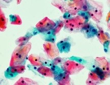 Un frotis citológico de vagina (tinción de Papanicolaou, x 1000), un ejemplo de un examen que salva vidas. GETTY IMAGES