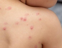 Los casos de contagios por viruela del mono en México registraron una alza de 177%. ESPECIAL