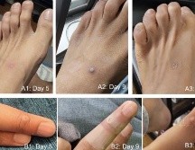 Los síntomas principales son lesiones en la piel o mucosas tipo máculas o pápulas en brazos, piernas y cara. ESPECIAL