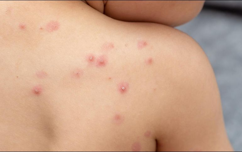 Se han registrado 386 casos de la viruela del mono en México. SUN/ARCHIVO