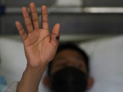 Los pacientes contagiados por la viruela del mono tienen registro de haber salido del estado. ARCHIVO/ SUN